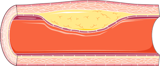Quais as diferenças das diretrizes internacionais em relação ao manejo da Doença Arterial Periférica?