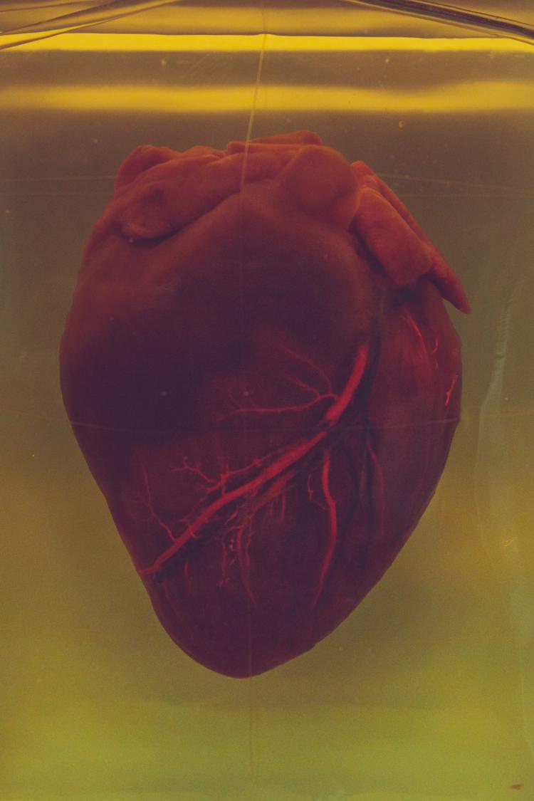 Alopurinol não ajuda a prevenir eventos cardiovasculares na DAC crônica