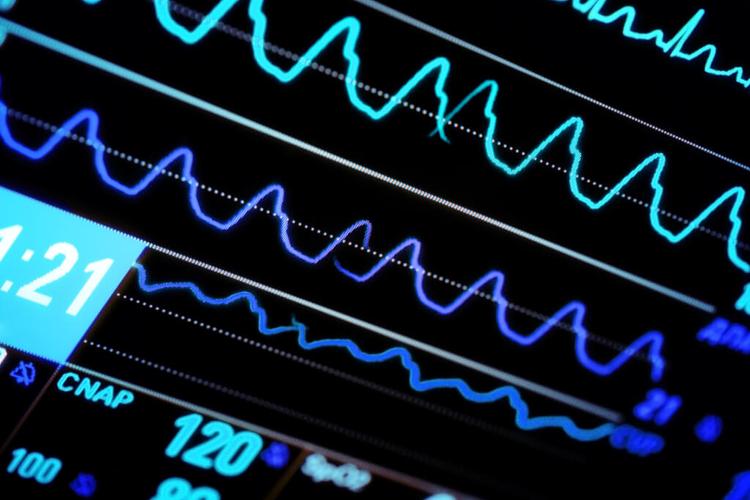 Ablação de Fibrilação Atrial em Pacientes com Insuficiência Cardíaca Pode Salvar Vidas?