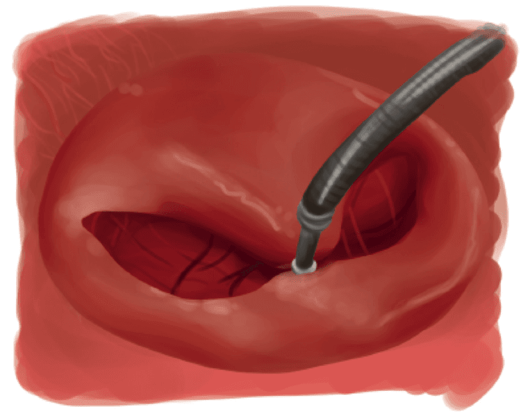 Mitraclip pode melhorar o prognóstico de pacientes com insuficiência cardíaca grave?