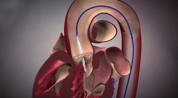 Já ouviu falar em Ventrículo Suicida?