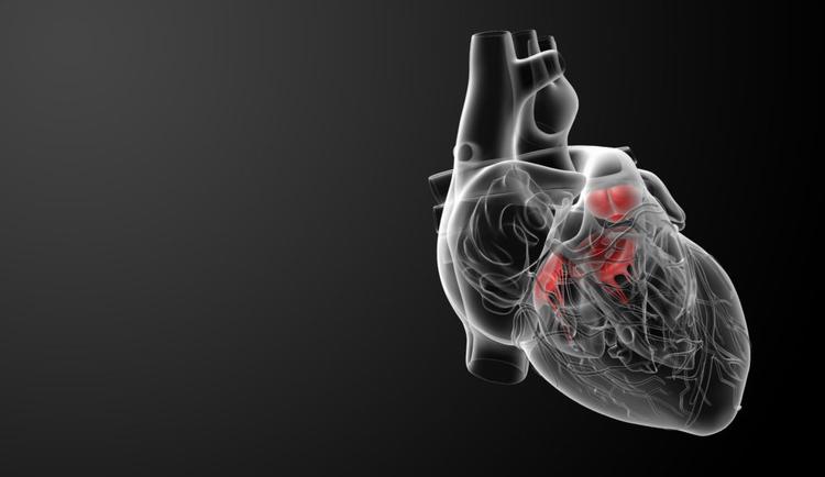 TAVI é uma opção para o tratamento de prótese valvar aórtica degenerada?