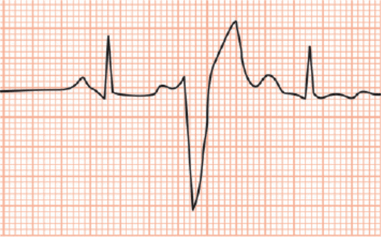 Quando pensar em taquicardiomiopatia?