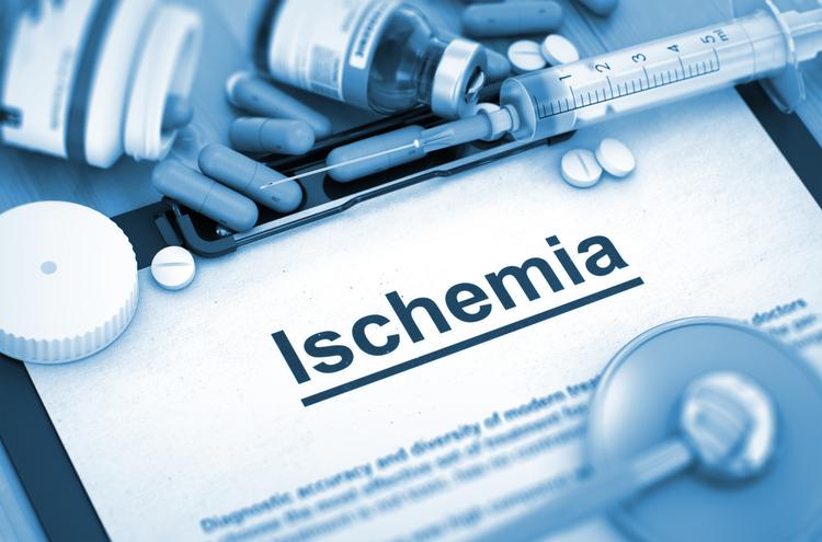Seguimento de longo prazo do estudo ISCHEMIA: muda alguma coisa?