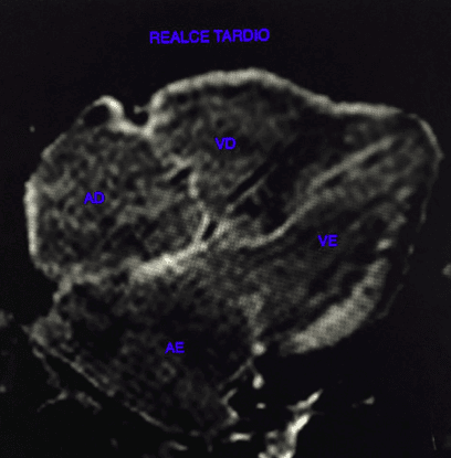 A Ressonância Magnética Cardíaca pode ajudar no diagnóstico de amiloidose cardíaca?