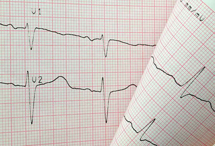 Por que a nova diretriz de ECG sugere abandonar o termo infarto posterior?