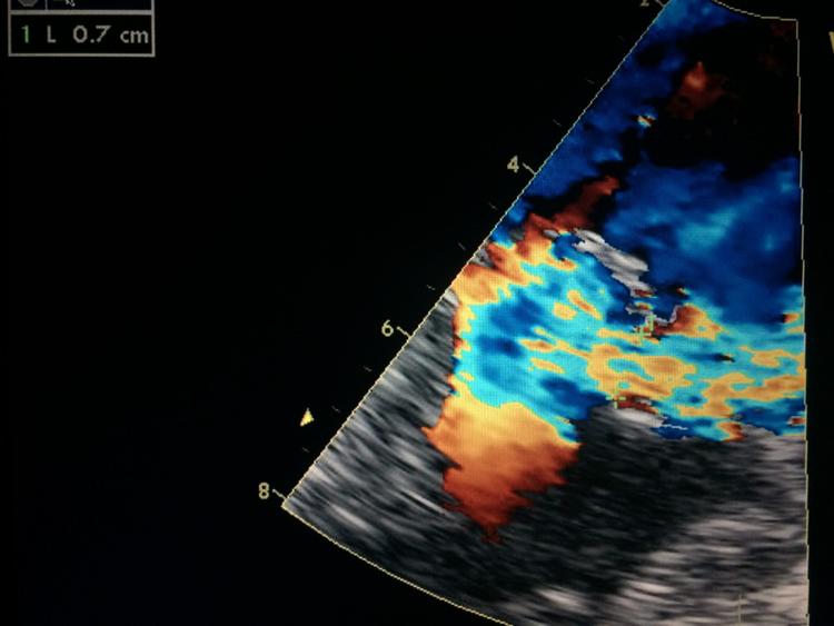 Curso básico de ecocardiograma - o que é vena contracta?