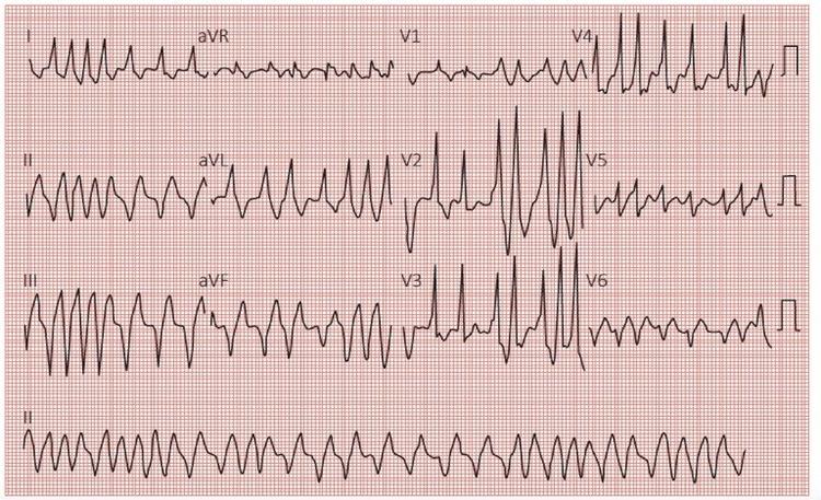 Quais as Novidades da Diretriz de Taquicardia Supraventricular? - Parte 2
