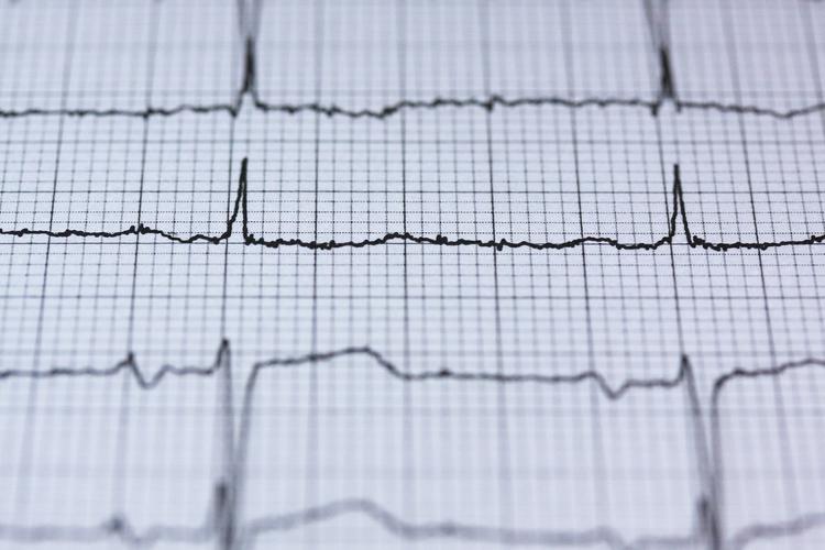 Eletrocardiograma no atleta - o que você precisa saber?