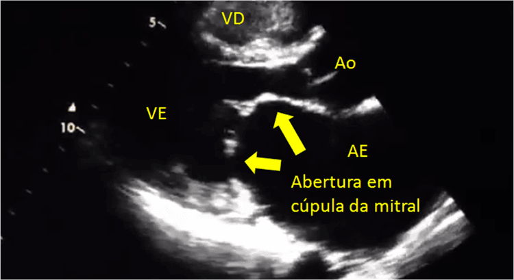 Quando indicar intervenção em pacientes com estenose mitral importante?