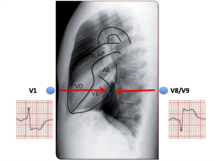 Onda R ampla em V1 + infarto = infarto de parede posterior, certo? Errado!