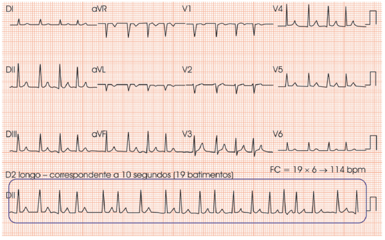 Fibrilação Atrial e Flutter em Paciente Assintomático: O Que Fazer?