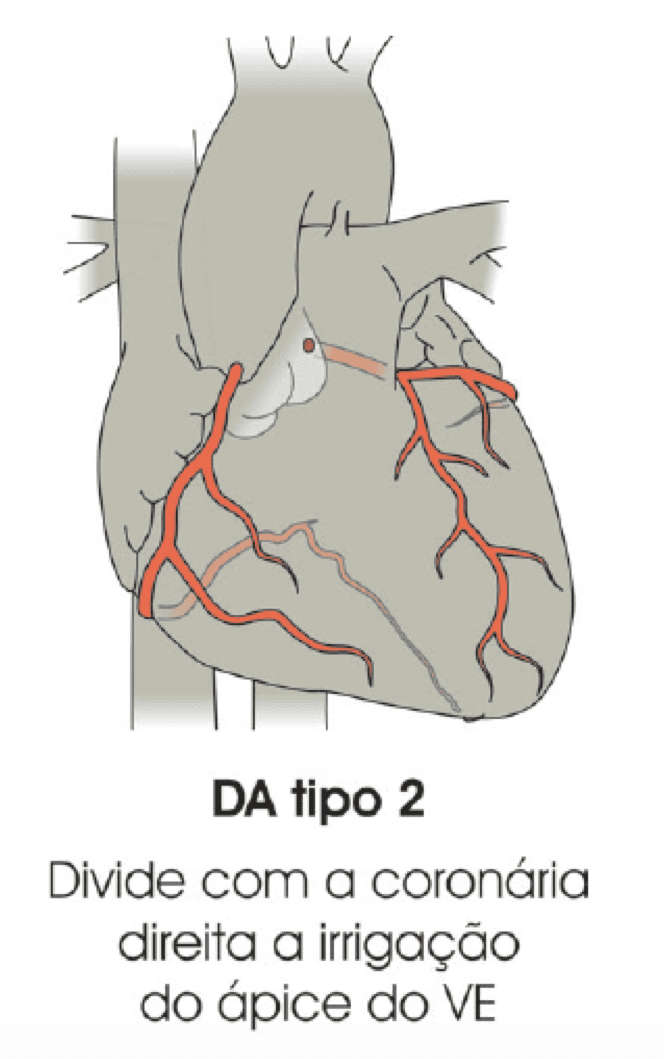 Quais os 4 tipos de artéria descendente anterior?