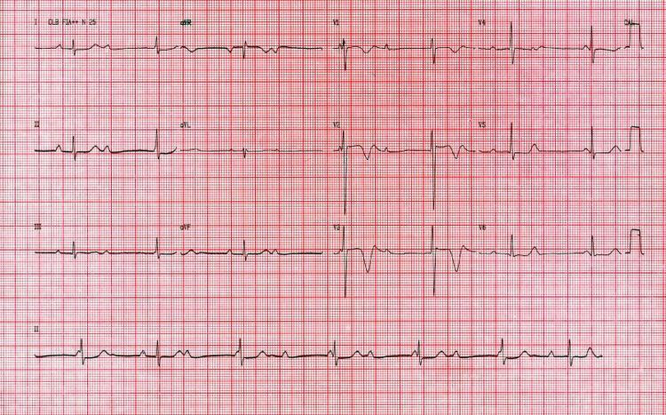 Que es el Síndrome de Stokes-Adams?