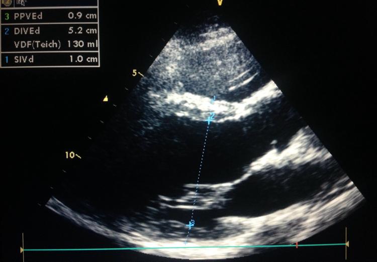 Como estimar a fração de ejeção do ventrículo esquerdo – método de Teichholz