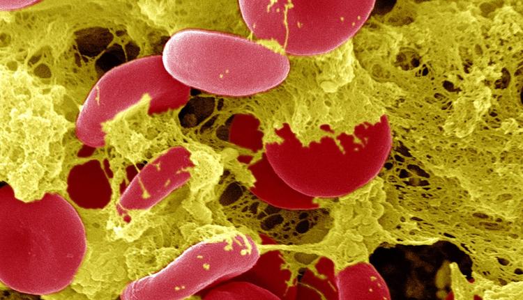 Qual o principal fator de risco para trombose de stent?