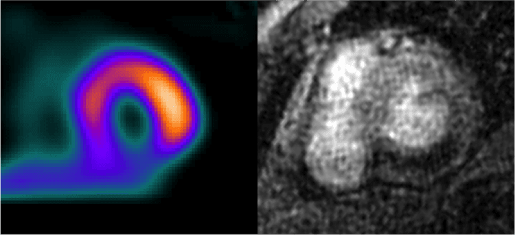 Qual melhor exame para investigar coronariopatia no BRE ?