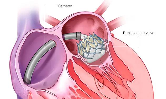 Já ouviu falar de Troca Valvar Mitral Transcateter?