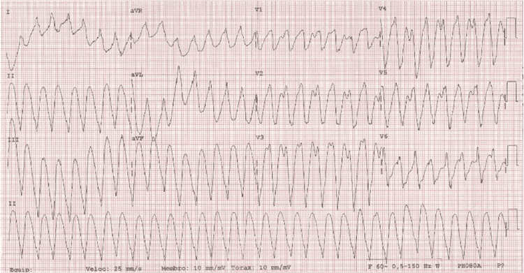 Meu Paciente Apresentou uma Taquicardia Ventricular Sustentada. E Agora!!! Indico CDI ou Ablação por Cateter?