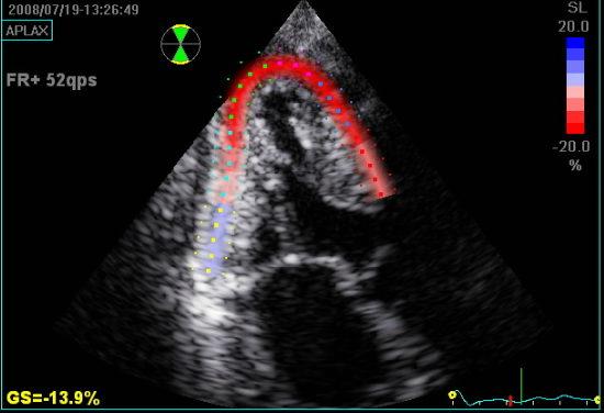 Strain Miocárdico: o que o cardiologista clínico precisa saber? Parte 1
