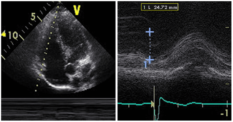 Curso básico de eco - o que é TAPSE????