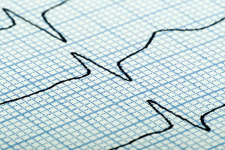 Desafio de ECG - Este ECG é Compatível com Qual Doença Abaixo?