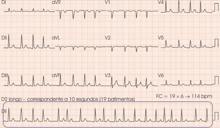 Como definir a frequência a cardíaca pelo ECG quando o ritmo cardíaco é irregular?