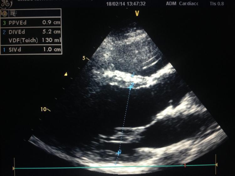 Novo guideline de medidas realizadas pelo ecocardiograma - o que mudou?