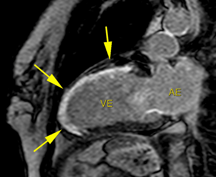 Onda Q no ECG = infarto prévio, certo? Está na hora de rever seus conceitos...