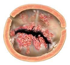 Recomendações para Profilaxia de Endocardite