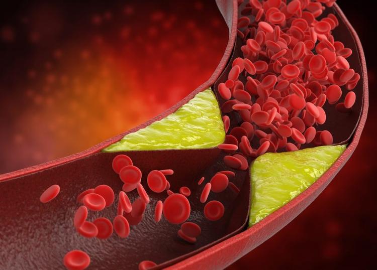 Inclisiran: nova medicação para tratamento de colesterol é aprovada pelo FDA