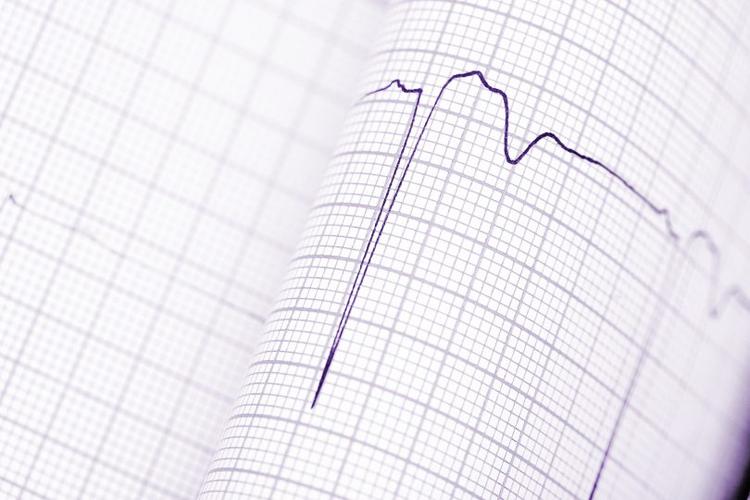 Onda T invertida no ECG sempre indica alteração cardíaca?