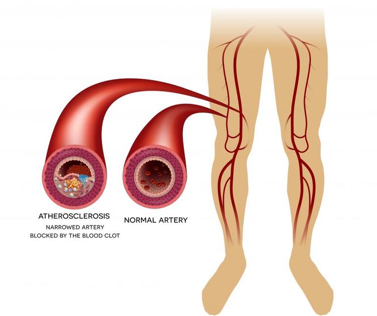 Índice tornozelo-braço – como medir e qual sua utilidade?